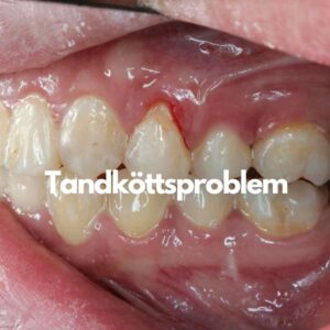 Tandköttsproblem- Tandköttskorrigering- Problems with tooth gums