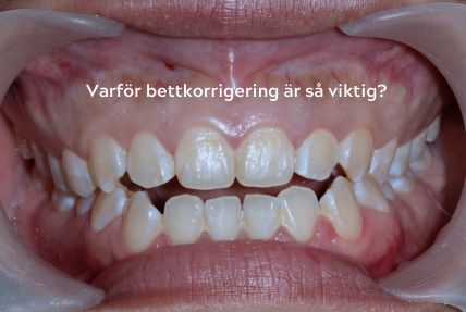 Varför bettkorrigering är så viktig – Råd från Gloss & Floss Dental Care